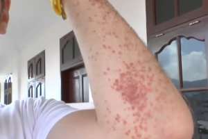 Szkolną bursę zaatakowały pluskwy