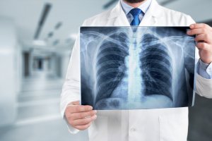 Diagnoza: Rak płuca