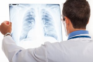 Płuca po pandemii wymagają szczególnej opieki