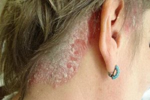 W Olsztynie polscy dermatolodzy rozmawiają o łuszczycy