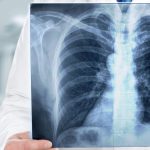 Profilaktyka raka płuc w Bartoszycach. „Mamy jeszcze wolne miejsca na badania”